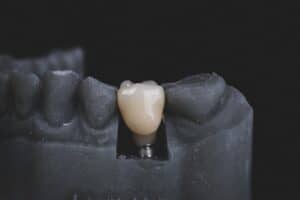  The Link Between Dental Implants and Overall Health