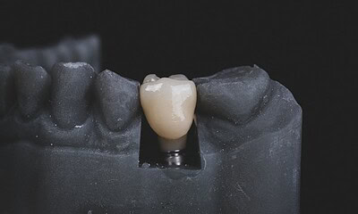 The Link Between Dental Implants and Overall Health