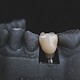 The Link Between Dental Implants and Overall Health